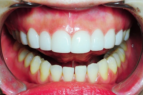 치아미백비용 아까워 셀프 미백했다가 후회하는 이유 관련 이미지 2