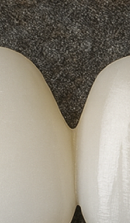 Systematic Examination Process to Review Before Deciding on Front Teeth Laminates image 38