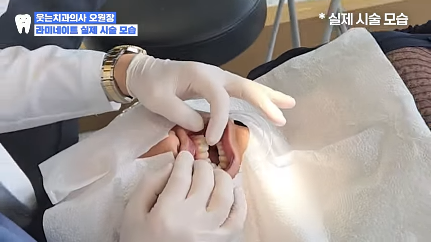 앞니살짝깨짐 빠르게 복원하는 방법 (레진, 라미네이트, 크라운) 관련 이미지 5