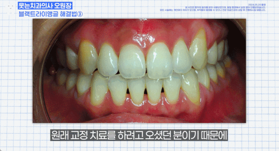 Black Triangle: 4 Ways to Fix the Gap Between Teeth <Revealed> image 20