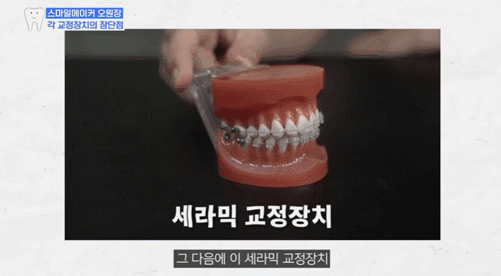 세라믹교정 vs 클리피씨교정, 뭐가 다르고 뭘 골라야 할까? 관련 이미지 4