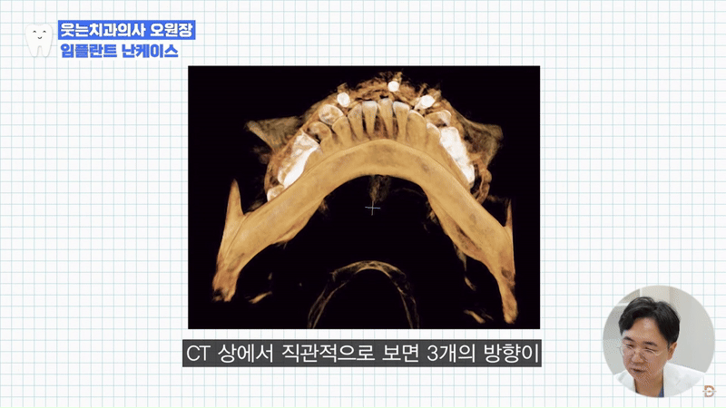 Looking Into Full Implant Placement Methods and Precautions image 7