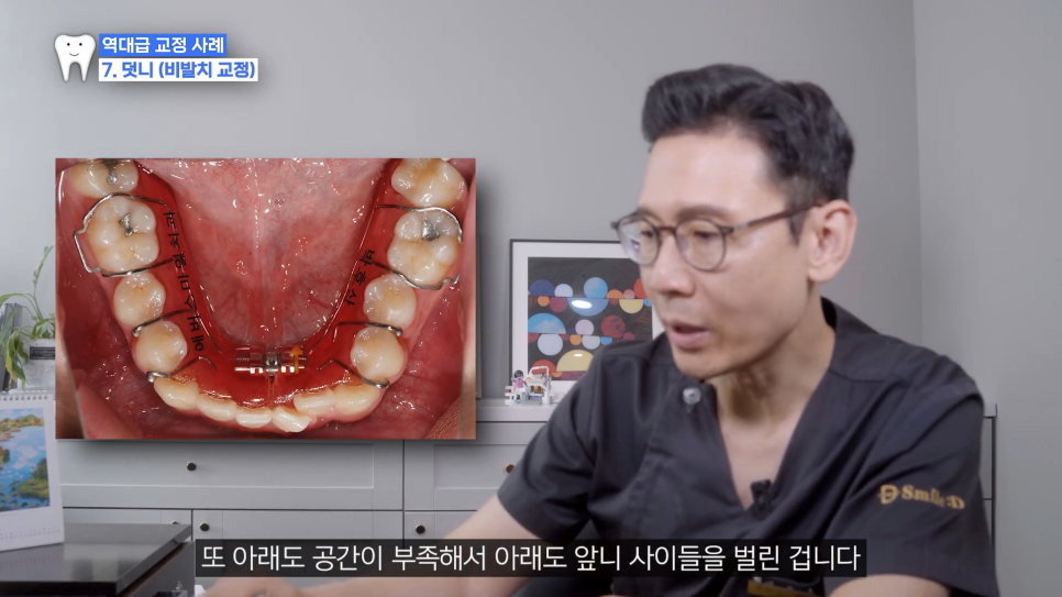 악궁확장 장치로 발치 피한 교정 사례, 나도 가능할까? 관련 이미지 7