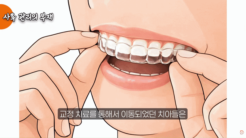 Orthodontic Side Effects: If You Start Without Knowing This, You’ll Regret It image 13