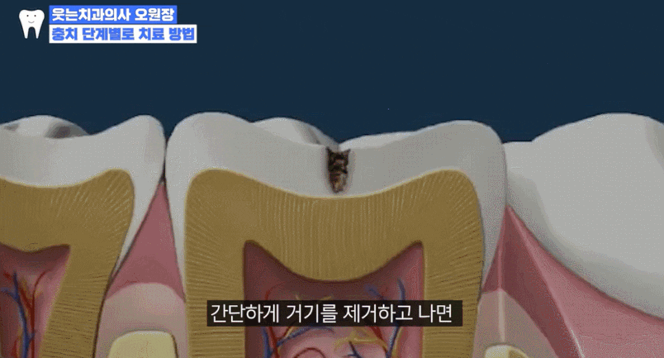 충치 자연치유 어렵기에, 충치단계 치료법 알아두세요 관련 이미지 8
