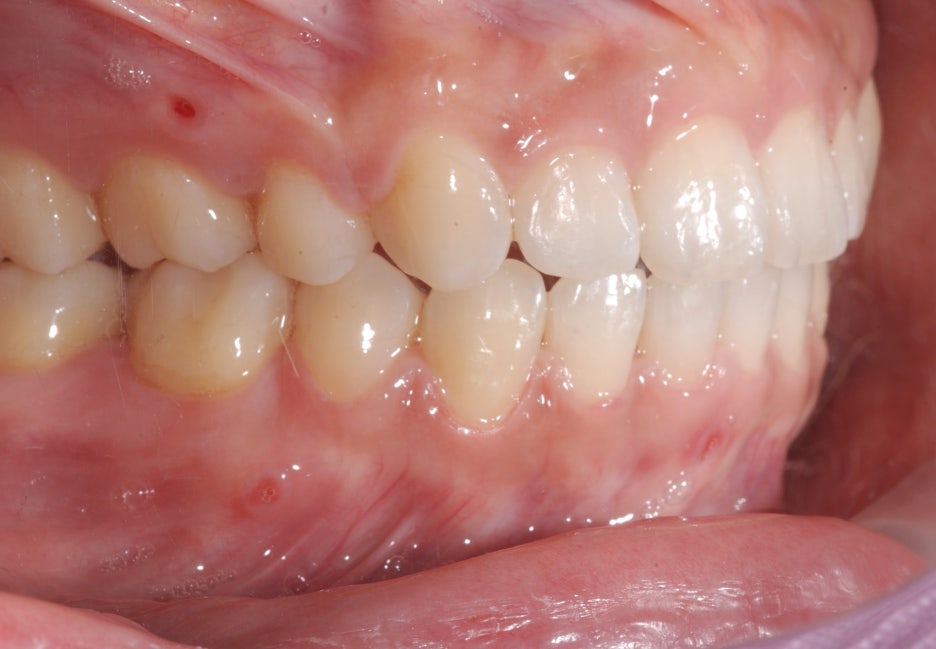Gap Between the Front Teeth? Don’t Judge It by Front Teeth Partial Orthodontic Reviews Alone image 6