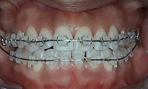 Can Extractions That Affect the Length of Correction for Crowded Canines Be Avoided? image 4