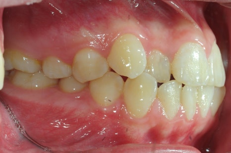 서울교정치과 가기 전 필독 내 치아, 정말 뽑아야만 할까? 관련 이미지 4