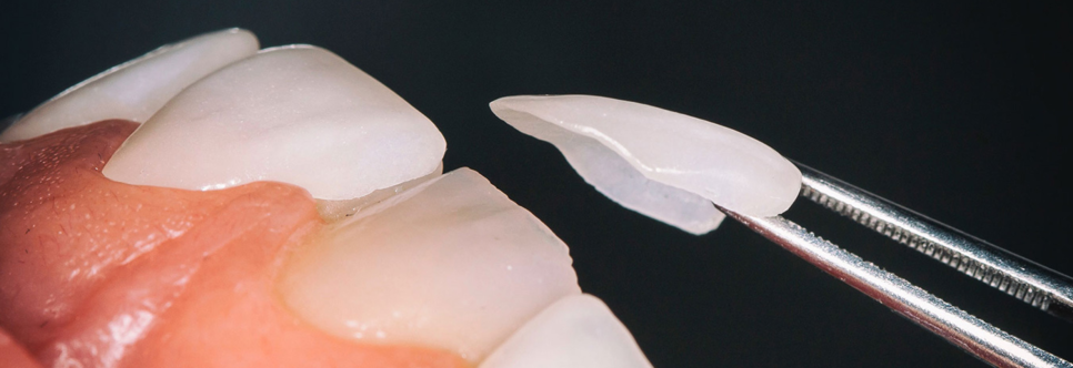 덧니 라미네이트와 덧니 교정, 뭐가 더 나을까요? < 18년차 전문의 답변> 관련 이미지 2