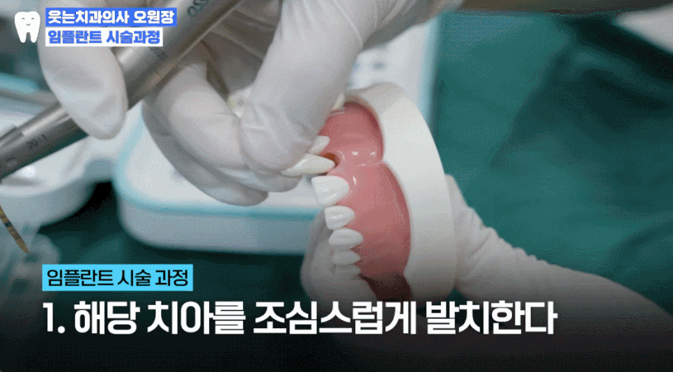 임플란트과정부터 임플란트 치과 고르는 팁까지 A to Z 관련 이미지 10