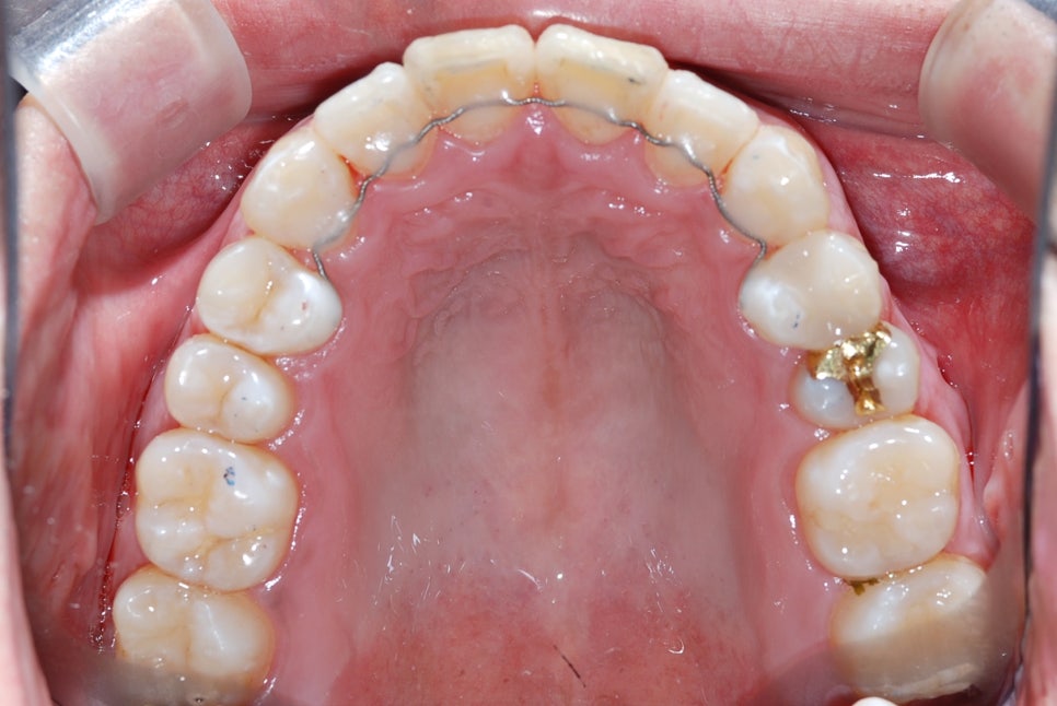 Front teeth gaps? Here are 3 solutions after adult orthodontic treatment image 9