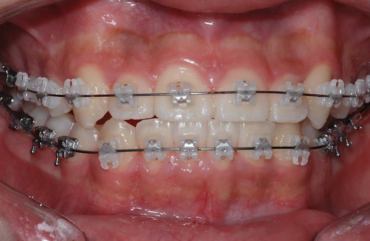 악궁확장 장치로 발치 피한 교정 사례, 나도 가능할까? 관련 이미지 8