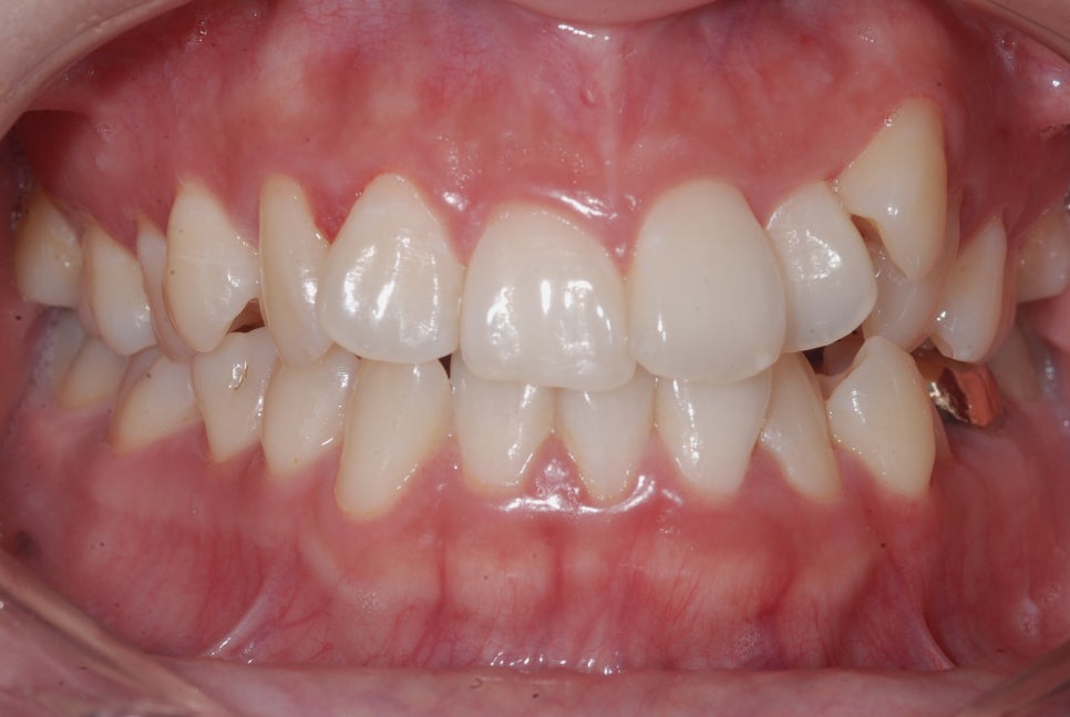 Crooked Teeth Correction? Cases Possible With Partial Orthodontics or Without Extraction image 12