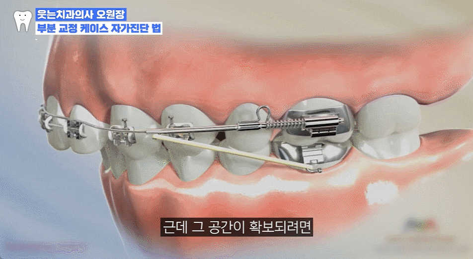 덧니 부분 교정 가능하려면? 2가지 봐야 합니다 관련 이미지 2
