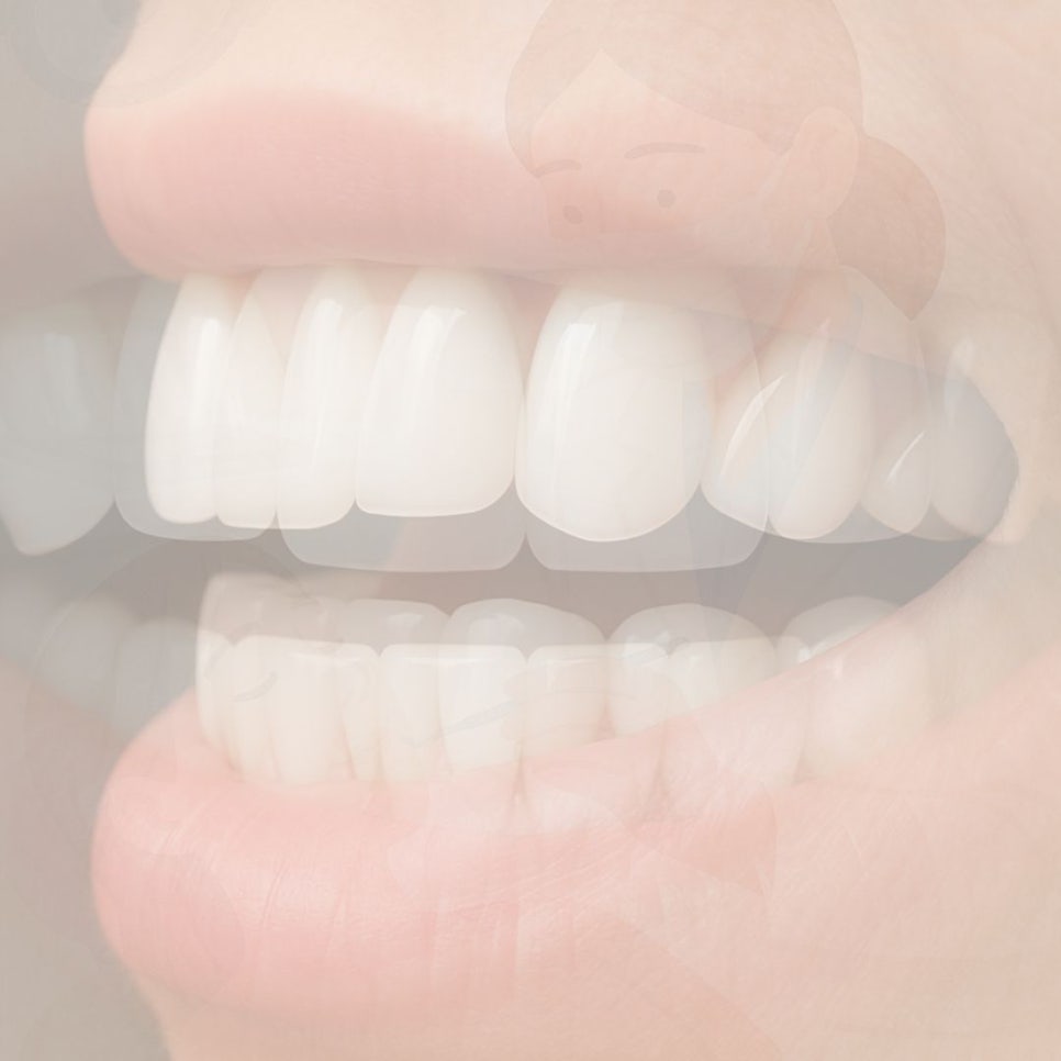 무삭제 라미네이트 후기 꼼꼼히 찾아봤어요 관련 이미지 34