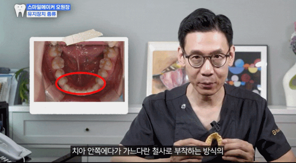 교정 유지장치 기간 평생해야 할까? 기간 딱 정리합니다 관련 이미지 3