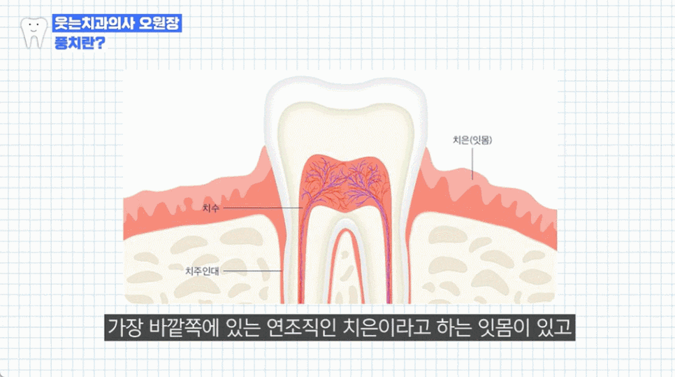 잇몸 염증 원인과 치료법 (치은염, 치주염 전격 분석) 관련 이미지 2