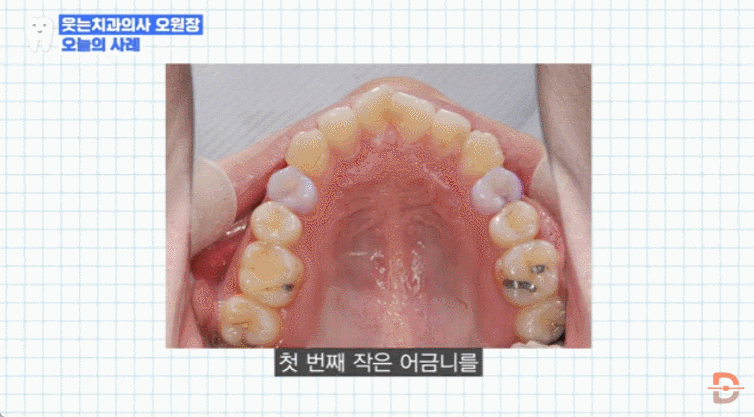 무턱교정 전후 사진만 찾아보고 있다면 반드시 확인해야 할 것들 관련 이미지 8