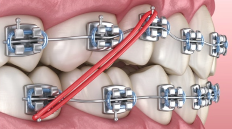 Why Do You Need to Wear Orthodontic Rubber Bands? Explaining Along with the Principle of Orthodontic Brackets image 6