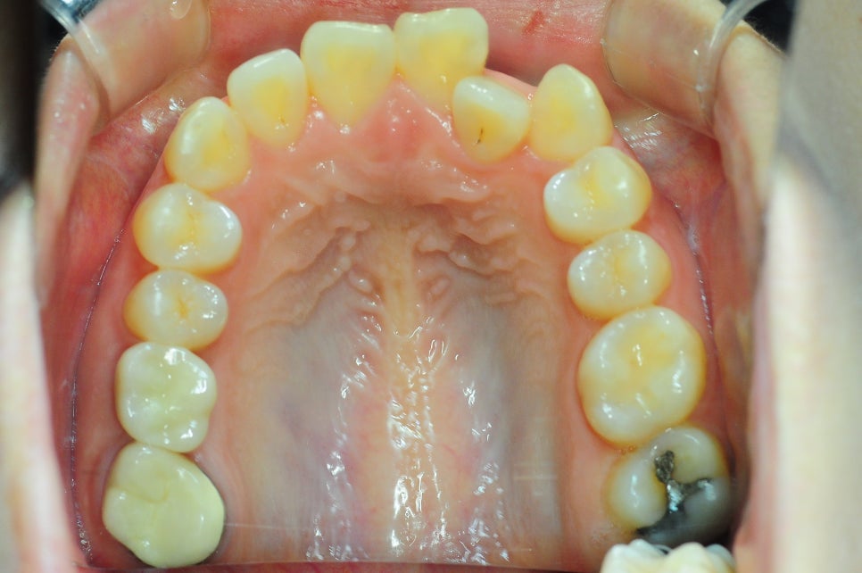 Does Invisalign Really Not Hurt? Do You Have to Have Teeth Extracted? image 7