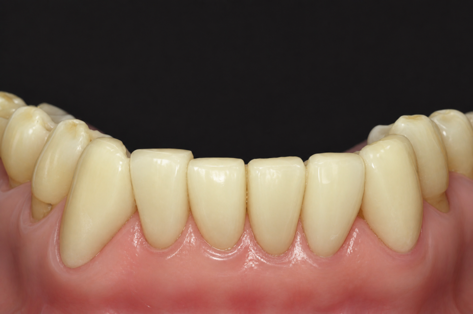 Want to Avoid Regretting Veneers? What to Check Before the Procedure image 14