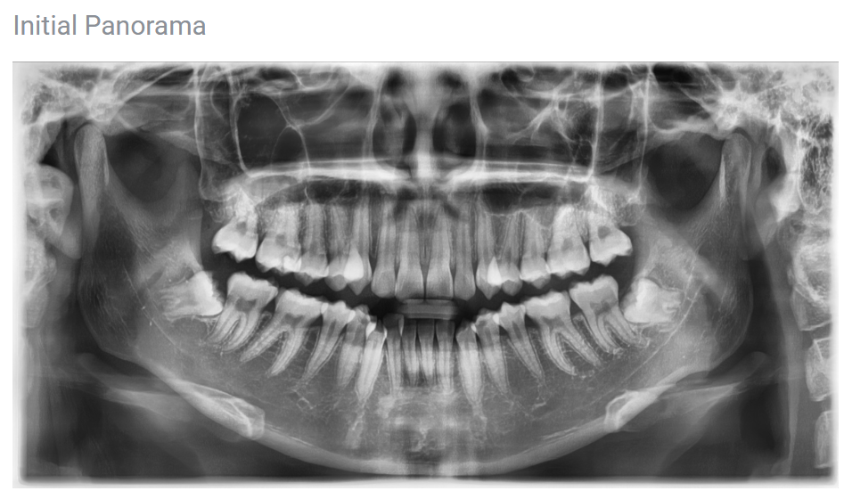 Non-extraction orthodontics? If you have this kind of protruding mouth, orthodontic treatment will not be effective image 18