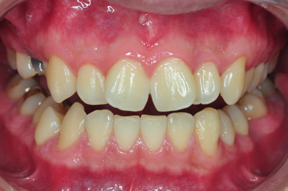 Laminates Review? Teeth Whitening? This Is for People Worried About Yellow Teeth image 7