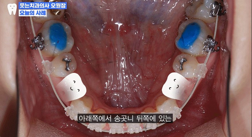 주걱턱 교정 VS 양악수술? 교정과 전문의가 답변드립니다 관련 이미지 12