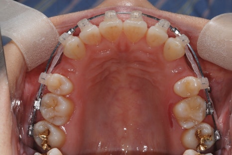 Protruding Mouth Correction and Underbite Correction: A Case Improved Without Surgery image 4