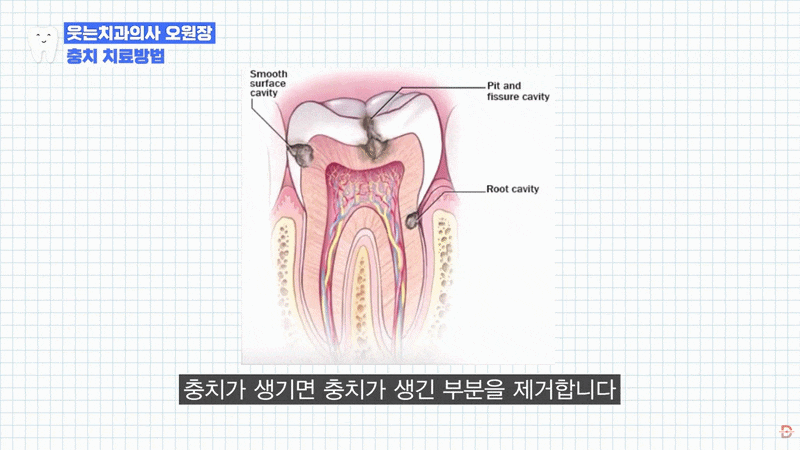 A Complete Guide to Drinking, Eating, and Tooth Sensitivity After Cavity Treatment image 12