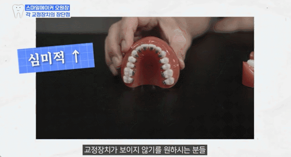 Before and After Protruding Mouth Correction: Principles, Advantages, and Disadvantages of Clear Aligners and Lingual Orthodontics for Protruding Mouth image 4