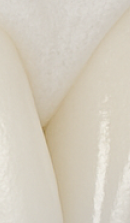 앞니 벌어짐 치료 전 반드시 체크해야 할 것들 정리 관련 이미지 32