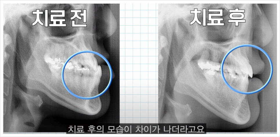 주걱턱 교정 VS 양악수술? 교정과 전문의가 답변드립니다 관련 이미지 15
