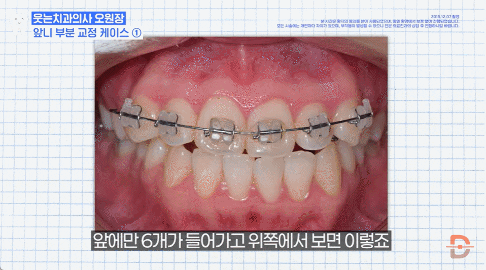 부분교정 장점, 관련 이미지 5