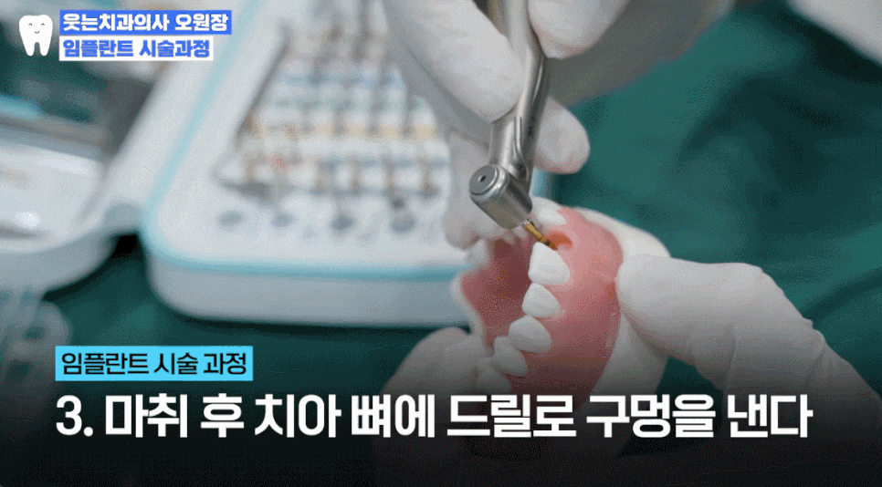 임플란트과정부터 임플란트 치과 고르는 팁까지 A to Z 관련 이미지 12