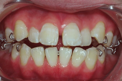 교정후앞니벌어짐, 2년간의 노력이 물거품? 관련 이미지 1