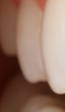 What to Check When Considering No-Prep Laminate Veneers in Gangnam image 36