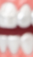 성인 돌출입 교정, 발치 없이도 변화가 가능할까? 관련 이미지 38