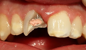 앞니살짝깨짐 빠르게 복원하는 방법 (레진, 라미네이트, 크라운) 관련 이미지 6