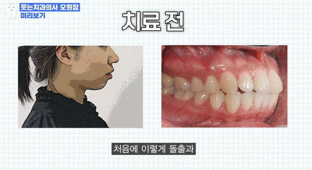 무턱교정 전후, 얼굴라인 달라지고 싶다면 관련 이미지 8