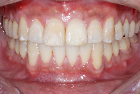 교정후앞니벌어짐, 2년간의 노력이 물거품? 관련 이미지 6