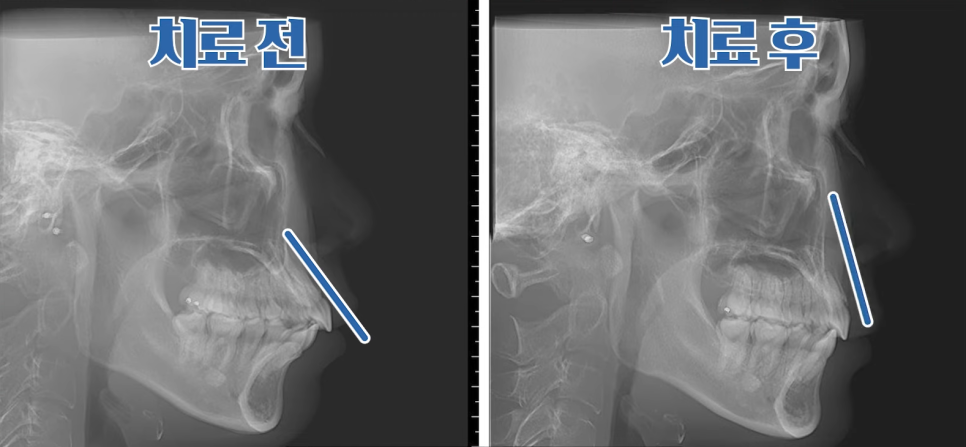 돌출입수술 대신, 인비절라인 돌출입 개선 사례 관련 이미지 15