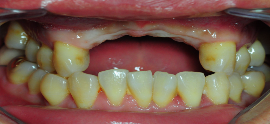 Implant Costs and Health Insurance Implant Coverage Criteria - If You Really Want to Save on Costs image 2