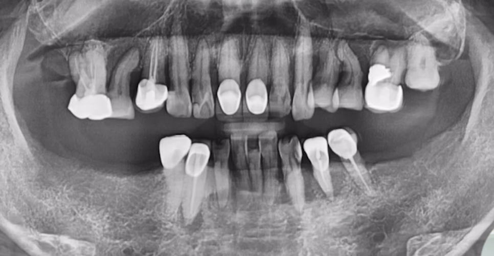 임플란트수술? 발치 즉시 vs 발치 후 임플란트 종류 따져보기 관련 이미지 6