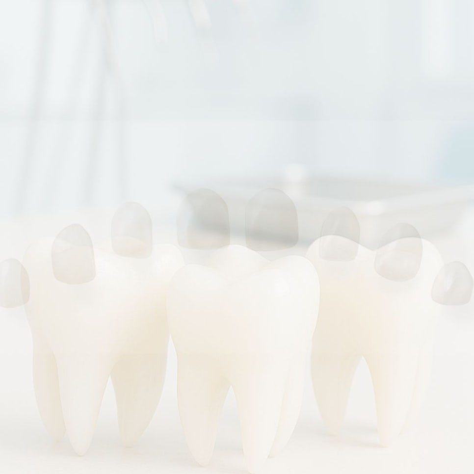 무삭제 라미네이트 후기 꼼꼼히 찾아봤어요 관련 이미지 21