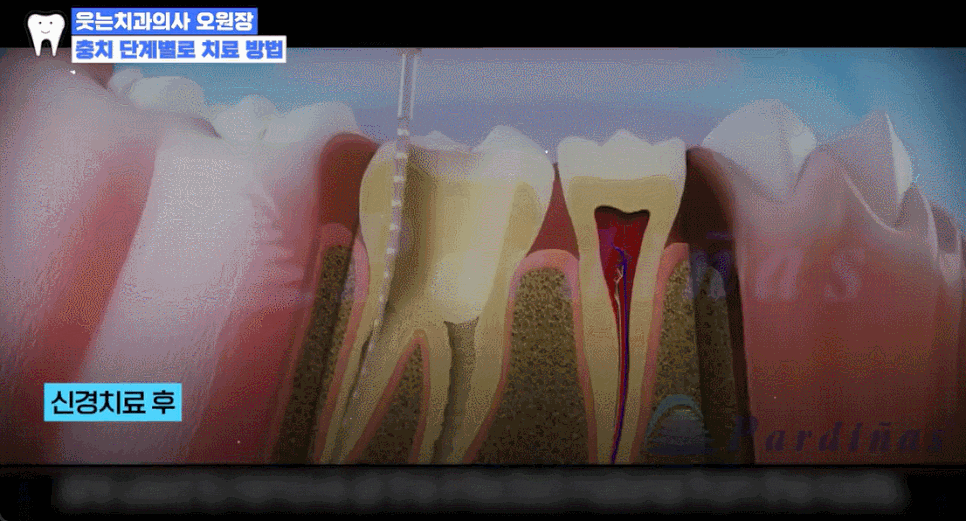 충치 자연치유 어렵기에, 충치단계 치료법 알아두세요 관련 이미지 11