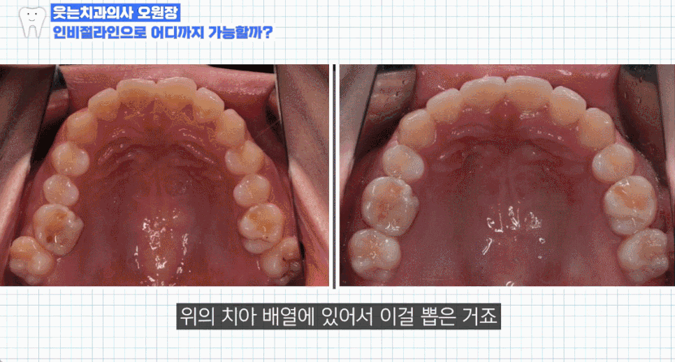 인비절라인 발치 여부에 대한 오해와 진실 알아보기 관련 이미지 14