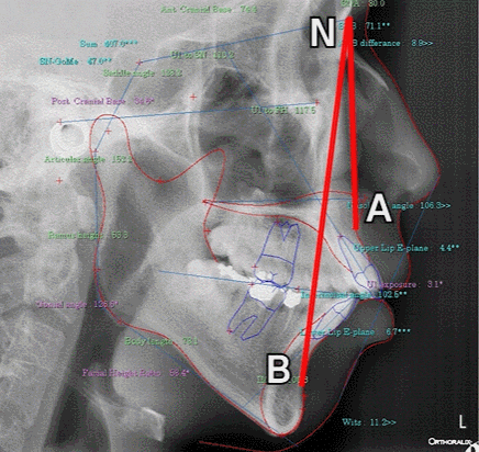 Underbite Tooth Correction? How to Improve a Receded Chin Without Double-Jaw Surgery or Chin Surgery image 3