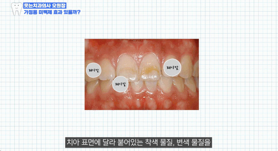 치아미백비용 아까워 셀프 미백했다가 후회하는 이유 관련 이미지 13