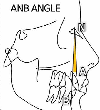 Underbite Tooth Correction? How to Improve a Receded Chin Without Double-Jaw Surgery or Chin Surgery image 4